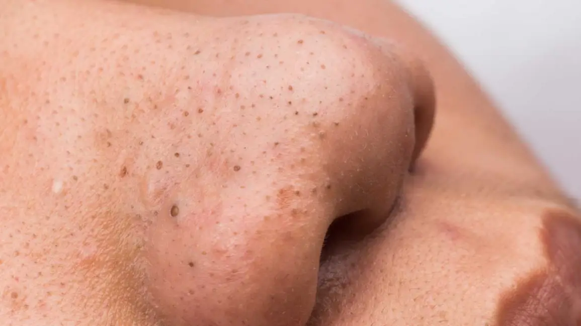 How to get rid of blackheads naturally at home