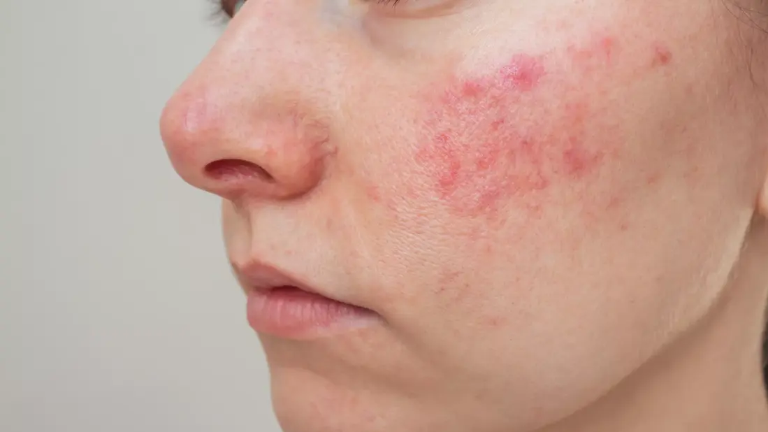 How to treat rosacea with natural ingredients