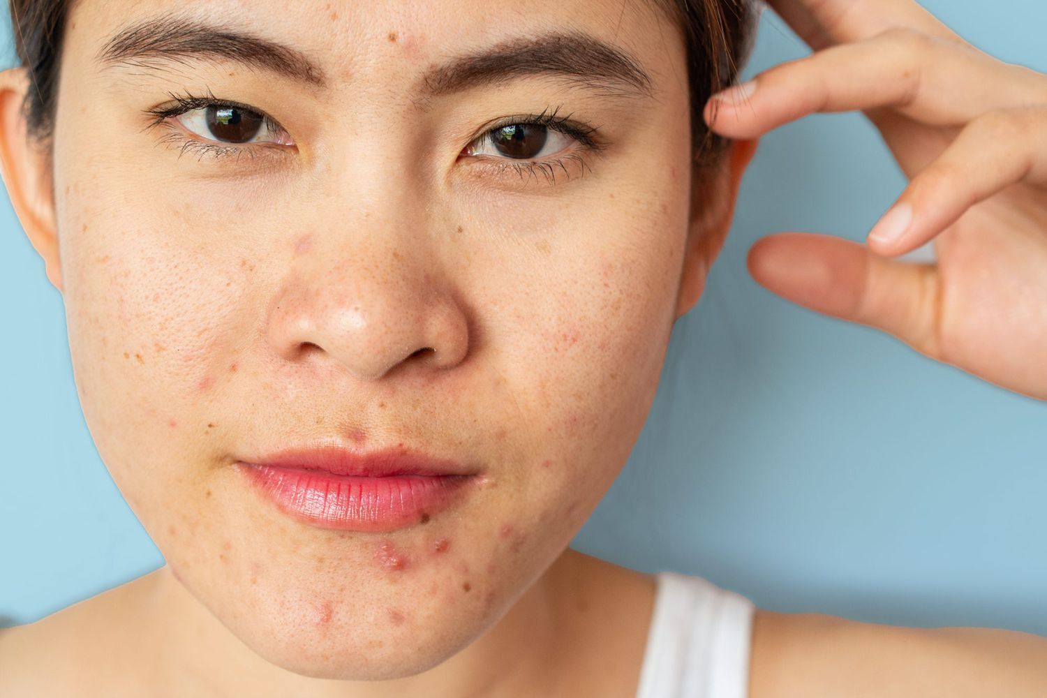 How to treat hormonal acne without medication