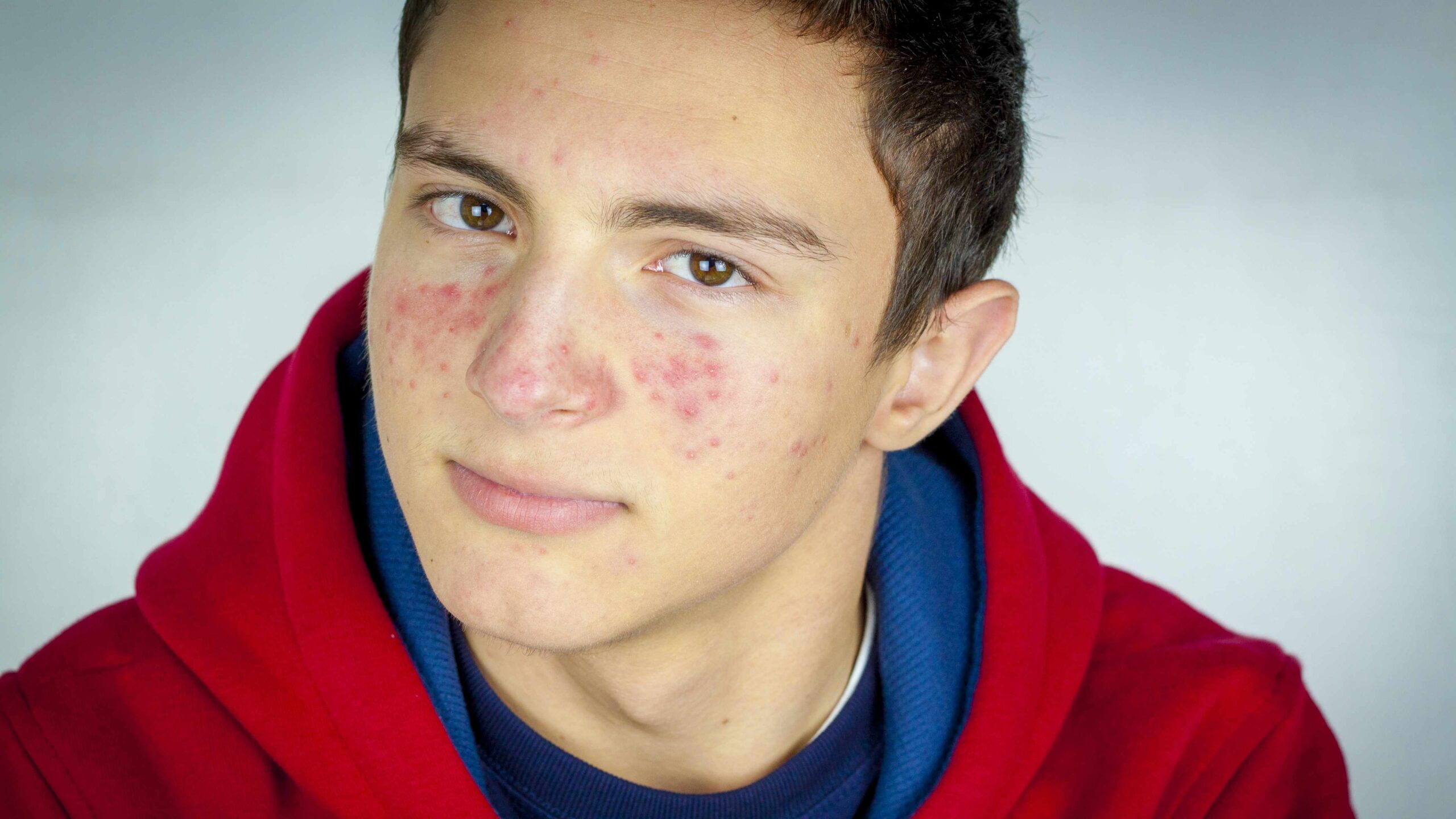 Pimples Homemade Solution