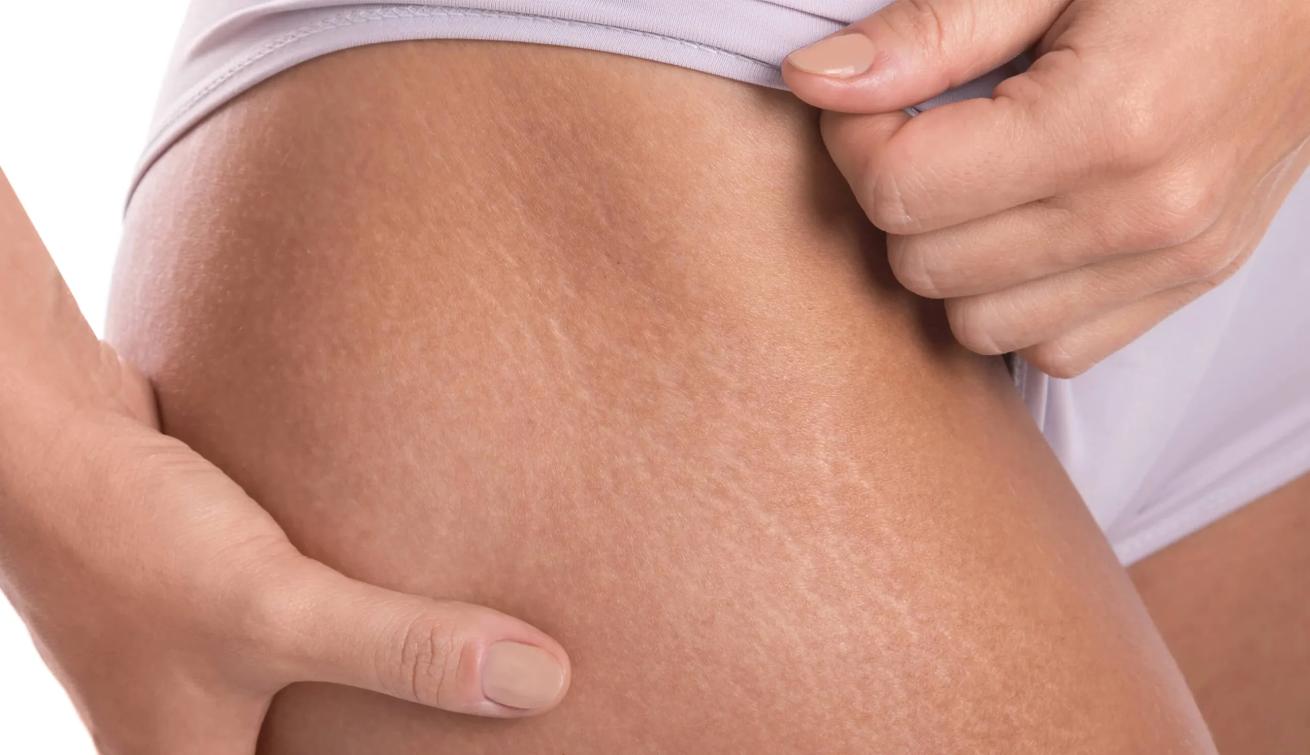 vitamin E oil benefits for stretch marks