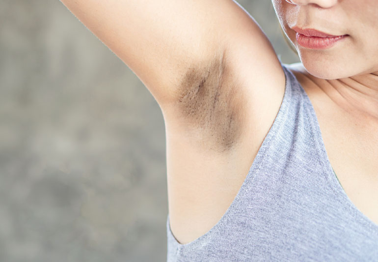 how to reduce underarm dark spots naturally
