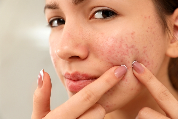 how to reduce redness and inflammation on face