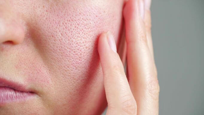 how to shrink large pores permanently