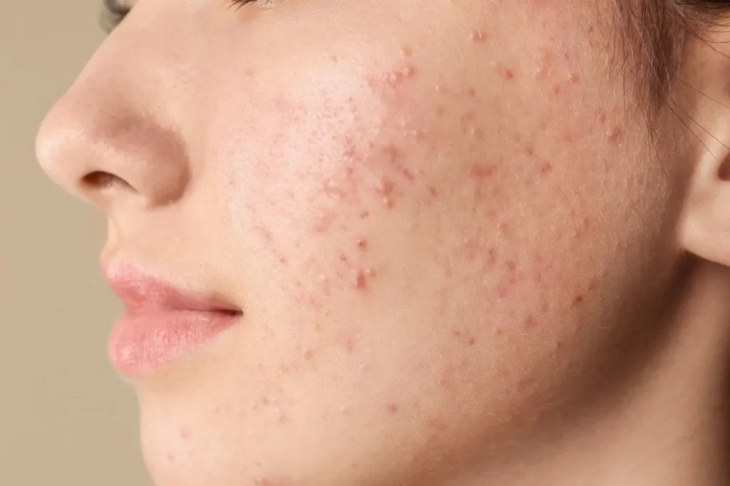 How to get rid of blackheads at home
