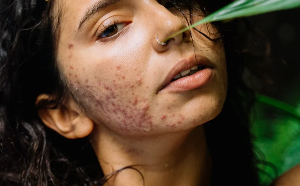 beauty tips for acne-prone teenagers