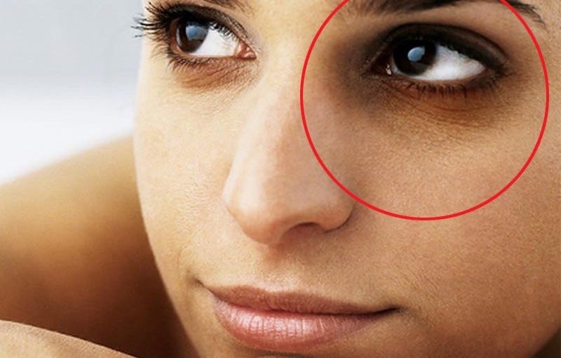 How to get rid of dark under-eye circles naturally