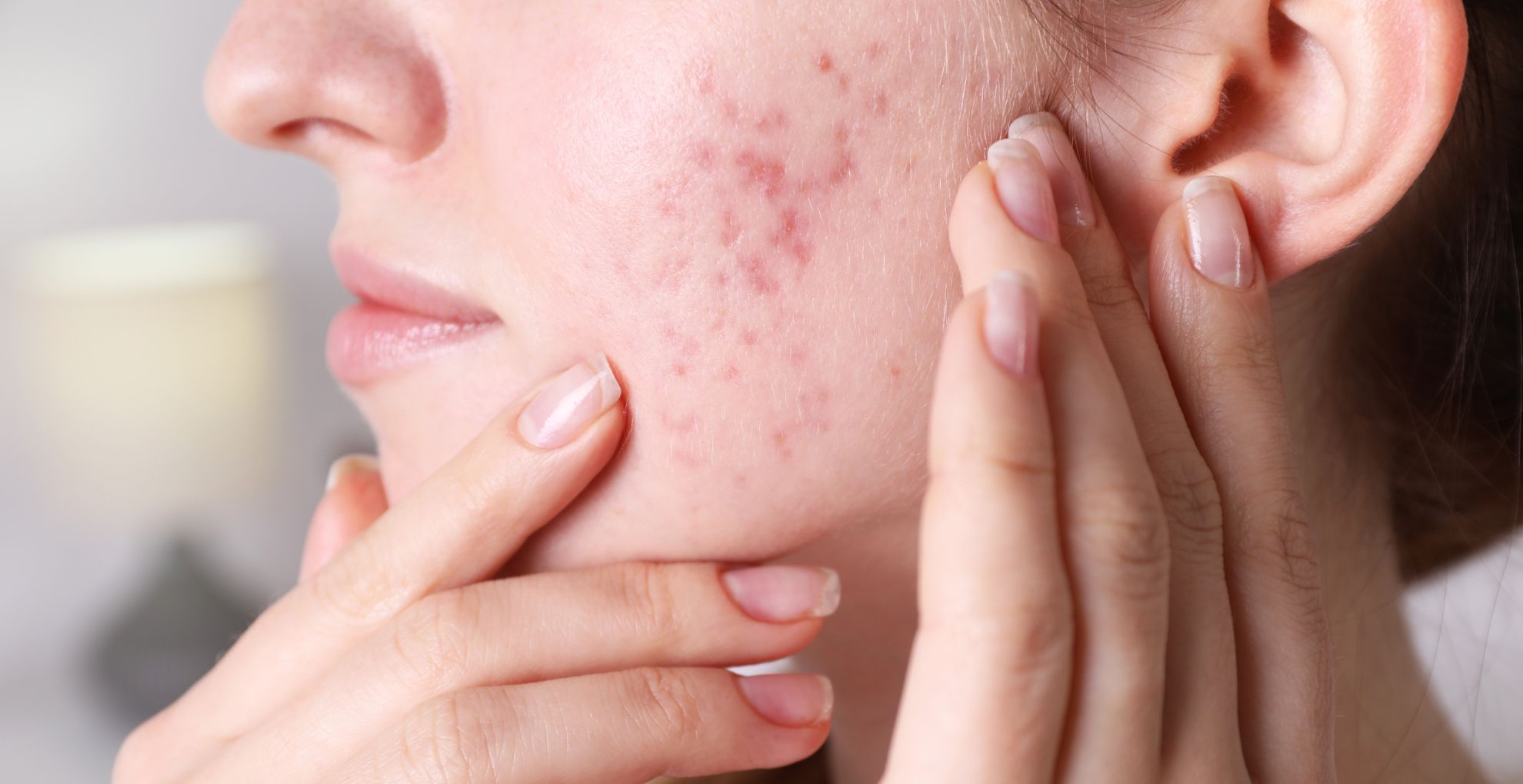 how to treat hormonal acne naturally