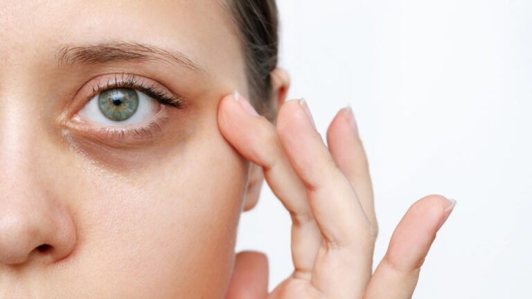 Natural remedies for dark circles under eyes