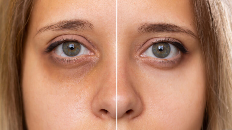 how to reduce dark circles under eyes naturally