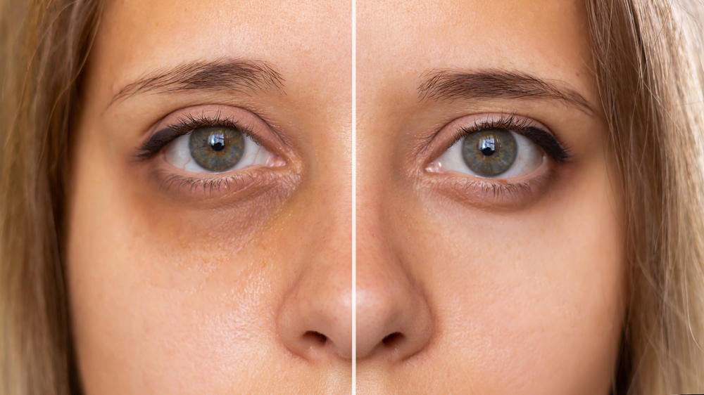 how to reduce dark circles under eyes naturally