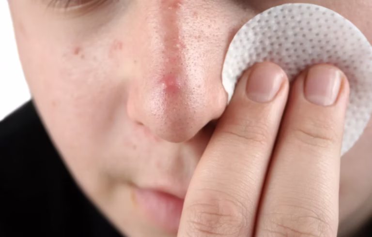 how to remove blackheads from nose safely at home