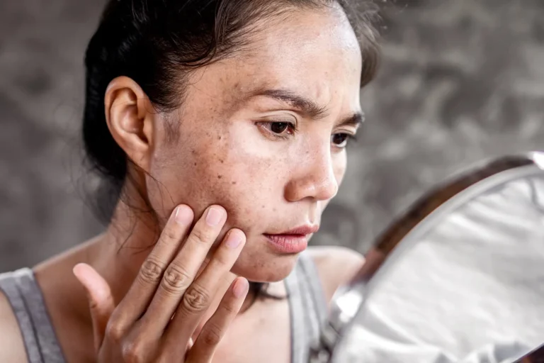 how to reduce dark spots on face naturally fast