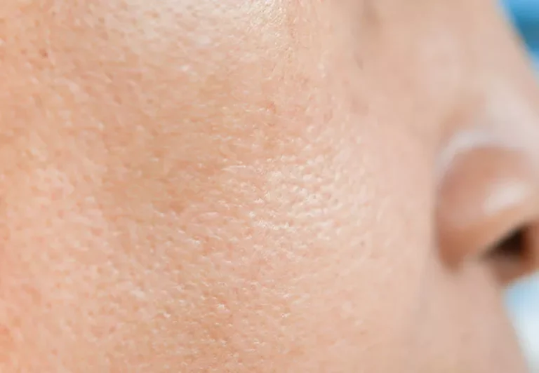 how to reduce large pores on face naturally and effectively