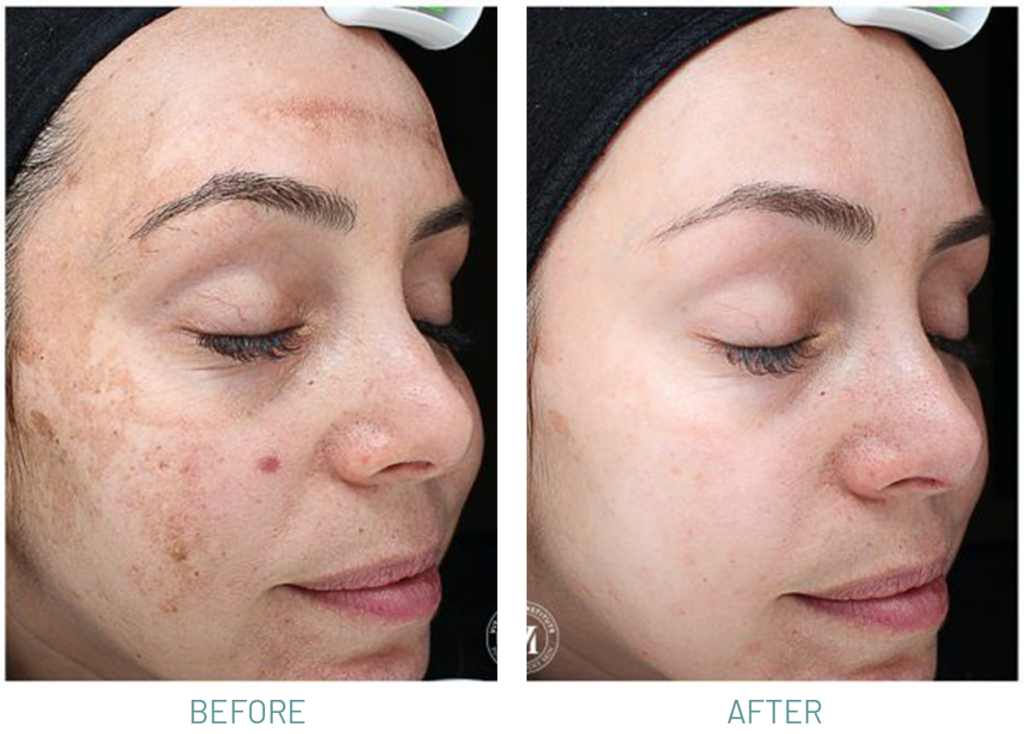 How to do at-home chemical peel safely