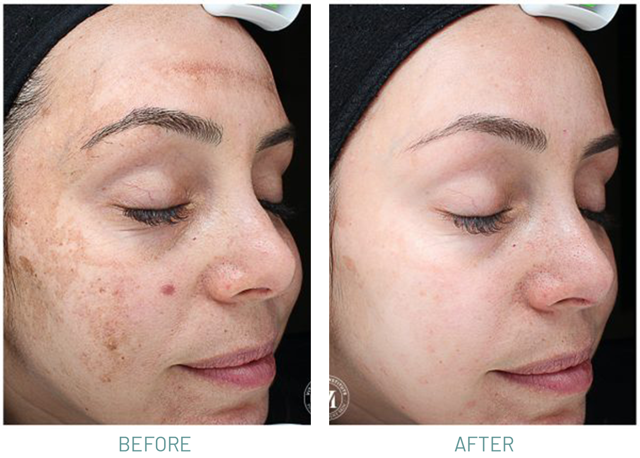 How to do at-home chemical peel safely