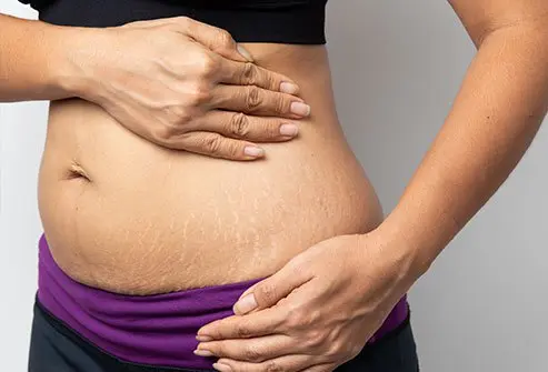How to fade stretch marks with home remedies