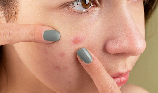 makeup routine for acne-prone skin without clogging pores