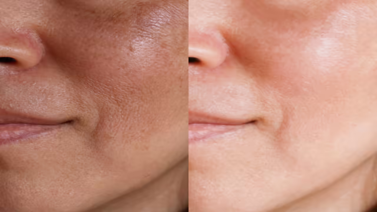 how to reduce open pores on face permanently at home