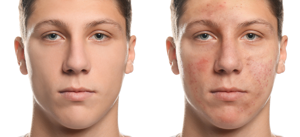 how to get clear skin fast for teenagers naturally