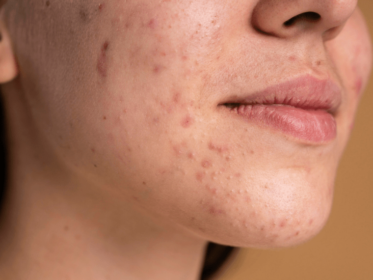 how to repair damaged skin barrier quickly