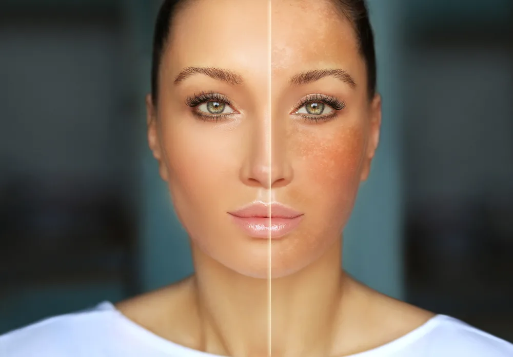 Natural remedies for dark spots and uneven skin tone