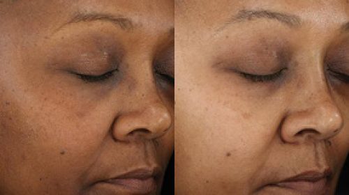 how to treat hyperpigmentation on dark skin tone