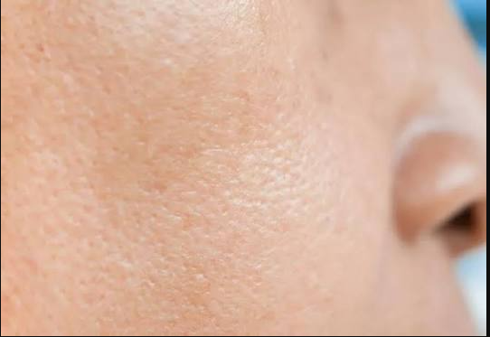 How to reduce large pores on the face naturally