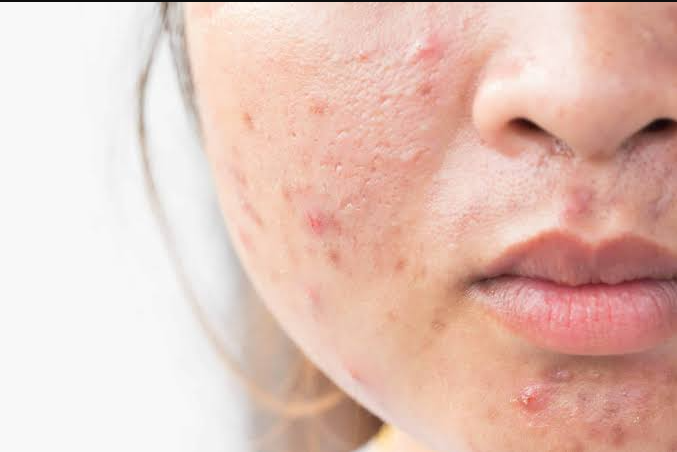 How to remove acne scars naturally and safely