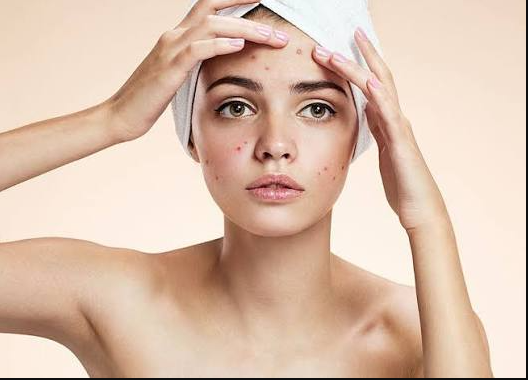 best skincare routine for acne prone skin