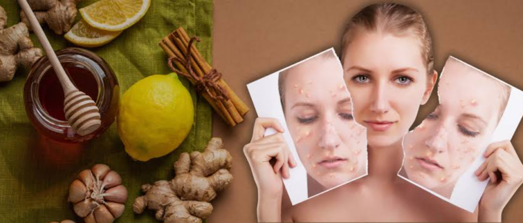 How to Reduce Acne Naturally at Home