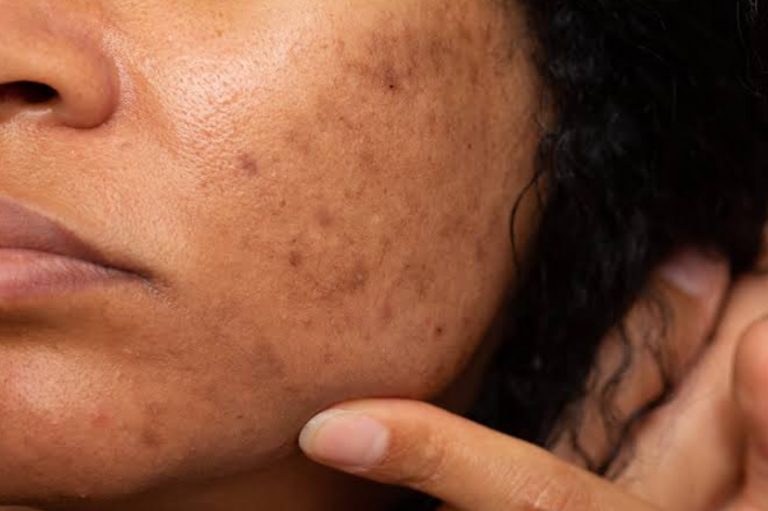 How to Get Rid of Dark Spots on Face
